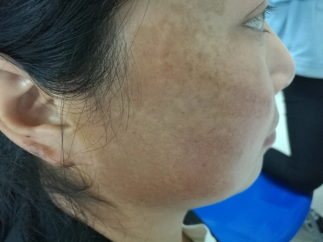 湘雅皮肤专家知道长黄褐斑的6个原因后从根源解决祛斑