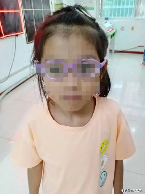 心痛:南阳8岁女孩近视1475度 专家:眼球就像要快被吹爆的气球_手机