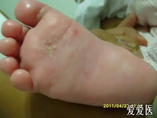 原创六--疥虫的成长