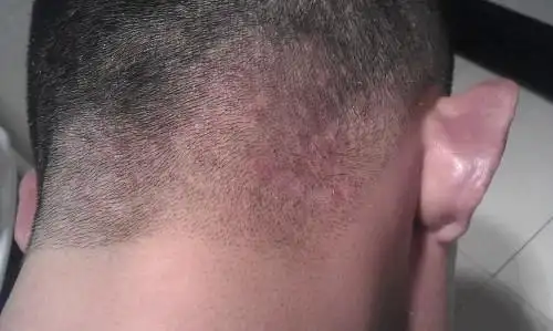 后脑勺起小红块,一片一片的,有半个脑袋的了