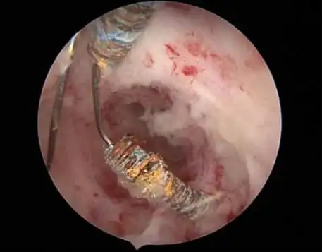 【妇科宫腔镜篇】宫腔镜下取环