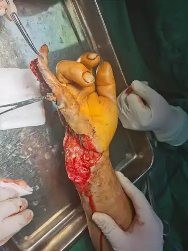 右手严重爆炸伤无感染修复成功