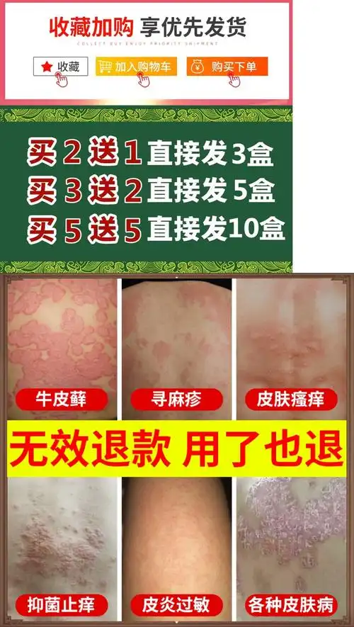 腋毛藓症状,腋毛癣不治疗可以吗