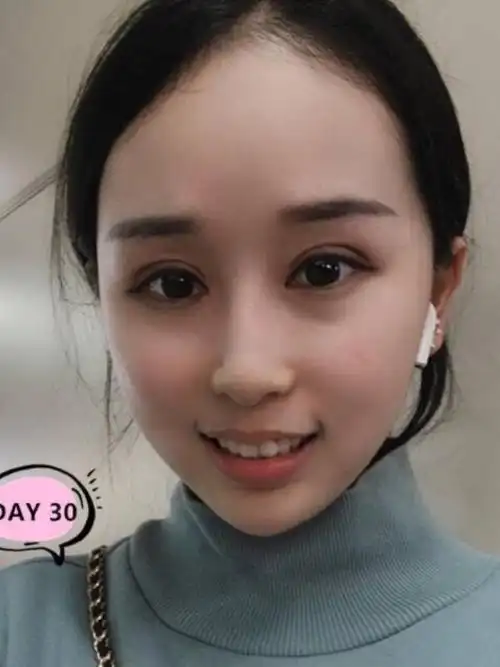 做双眼皮如何避免显假,不自然?