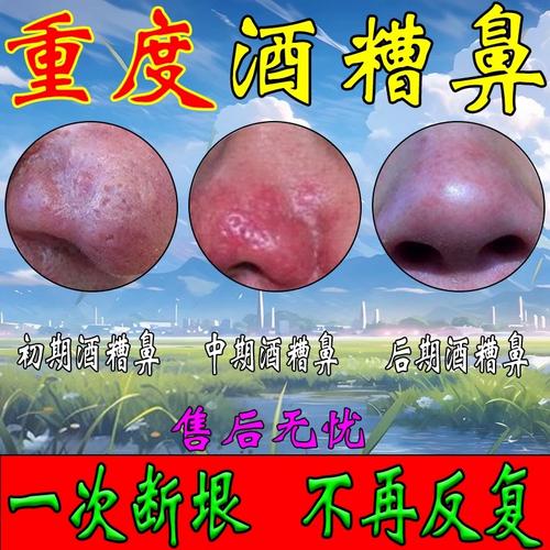 酒糟鼻草莓鼻修复去红鼻头鼻子两侧红肿泛红血丝毛孔粗大专用药膏