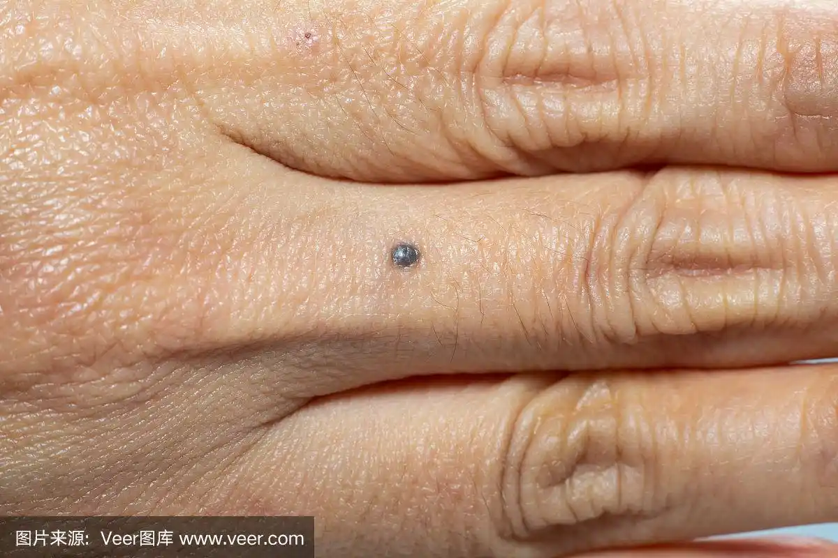 健康保健,女人,痣,皮肤,手指