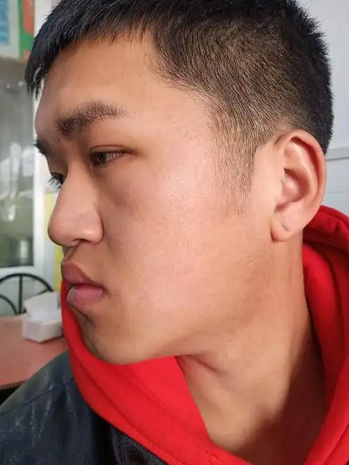 上面的照片就是我的术前照 第一张 正脸 第二张 侧脸 第三张 45°脸