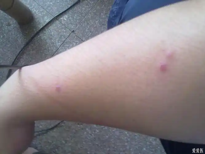 看图诊病——毛囊炎?