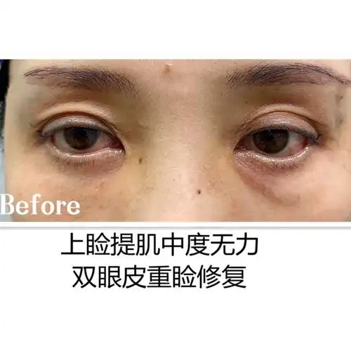 平时觉得眼睛没神的朋友们,可以考虑一下自己是不是【提肌无力】的