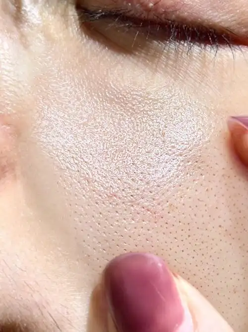 扎心的大油皮6015痘痘闭口先不说毛孔还很特大_闭口_痘痘_精华