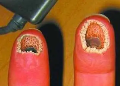 极度恶心的十大人体寄生虫,莲蓬乳是真的吗?