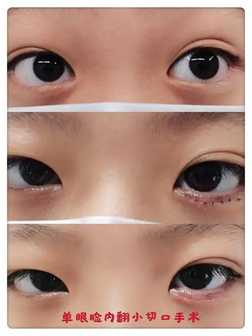 瘢痕明显吗?_睑内翻_睑内翻治疗方式 - 好大夫在线