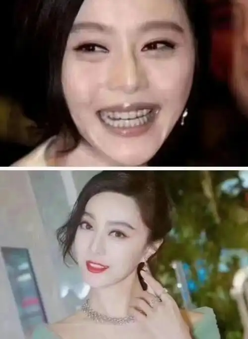 明星们和他们的烤瓷牙