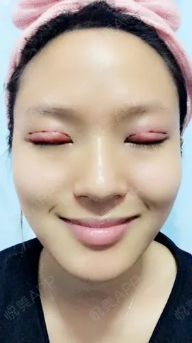 定点双眼皮术后第三天.