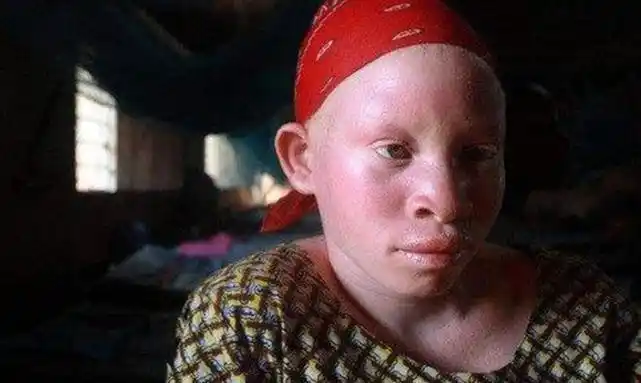 非洲黑人生下白皮肤孩子血液比黄金都贵需警察24小时保护