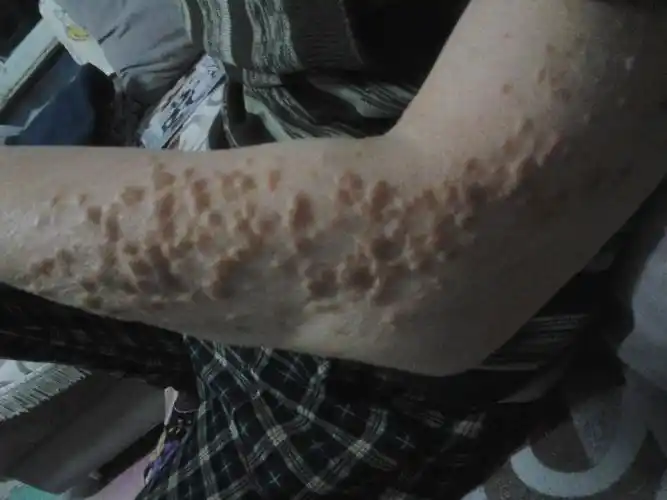 胳膊上起的红疙瘩硬的,20年了,有时疼痛,拜托哪位帮我看看是什么