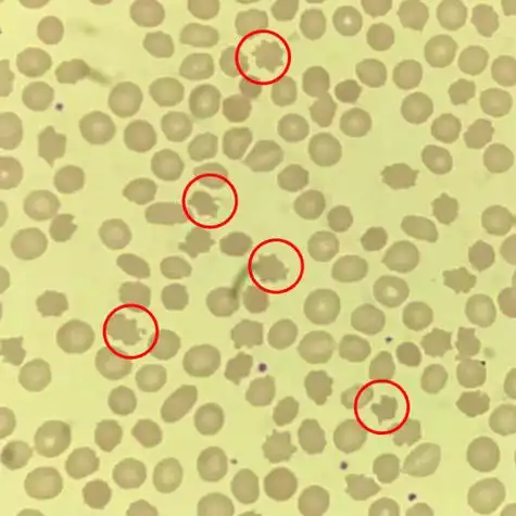 患者外周血涂片可见红细胞大小不一,棘形红细胞占17%(正常人棘红细胞