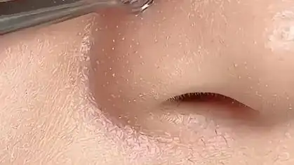 粉刺清理工具去黑头白头,特别方便,不要用手再去挤了,干净卫生"粉刺针