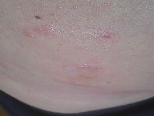胸前长红点,抓过后有小水泡连在一起,越抓越痒,晚上厉害.