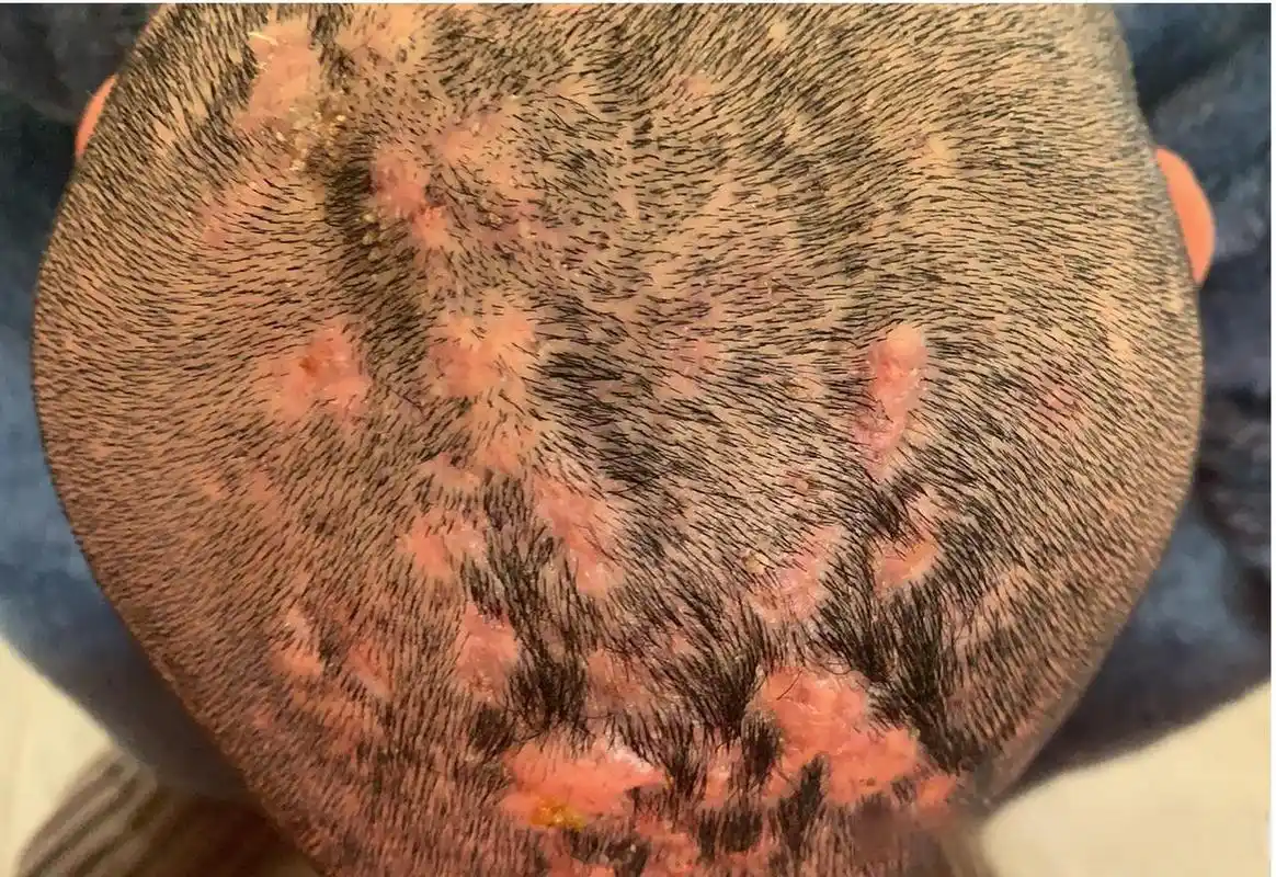 到里面有很多脓,并且大鼓包下面都是连通的,这种,就叫做穿掘性毛囊炎