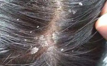 只用一个植物,1月让你彻底摆脱头皮屑__凤凰网