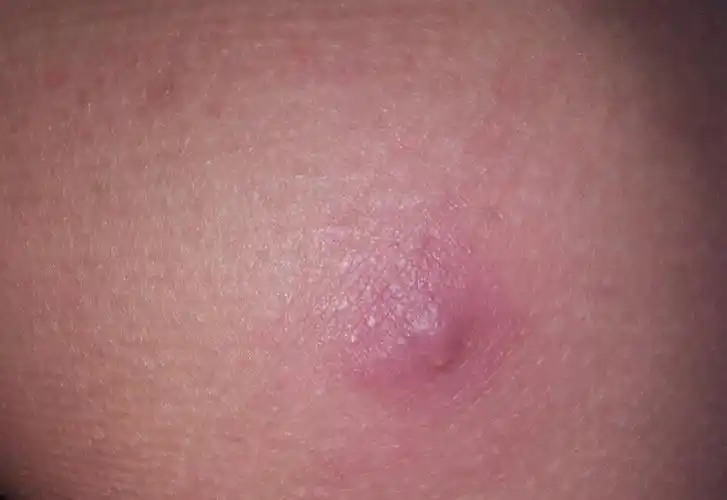 一碰就疼的一个包.是毛囊炎吗?严重吗?会致死吗?