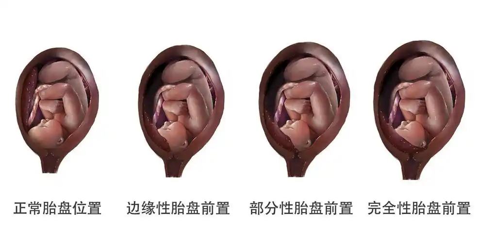 好孕爸日记67孕早期产检的胎盘前置状态不需要过分担心