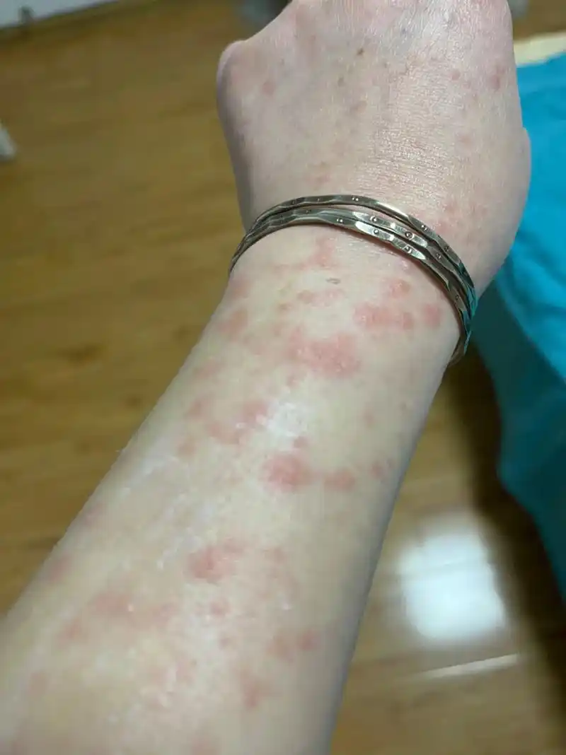 天天呆家还呆出皮肤病了,不痛不痒. - 抖音