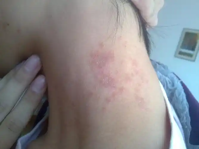 脖子上起的这片疙瘩是什么啊?太恶心了,怎么治啊