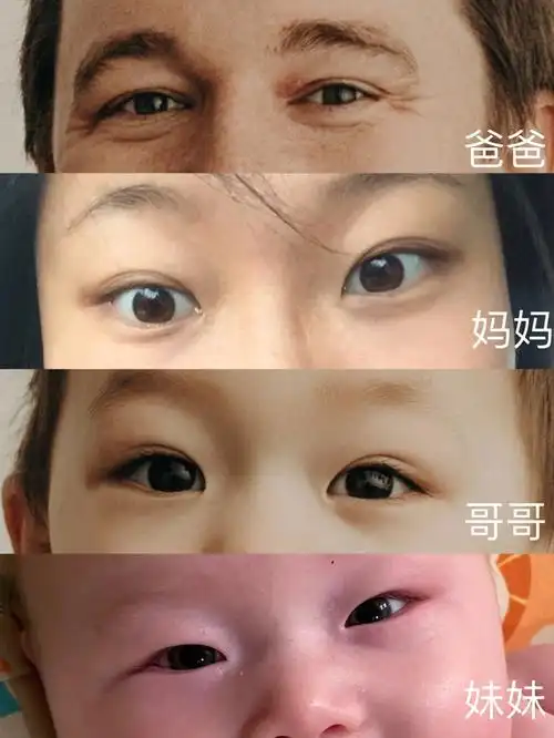 混血宝宝单眼皮有望变双吗