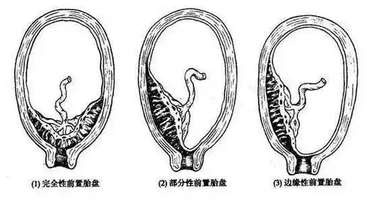 那胎盘前壁or前置胎盘,你分清楚了吗?_子宫_胎儿_活动