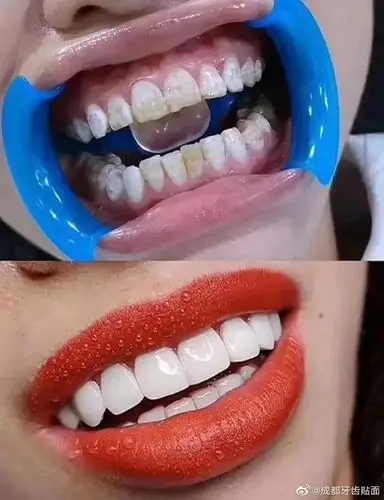 成都牙齿贴面的详细解析及修复效果