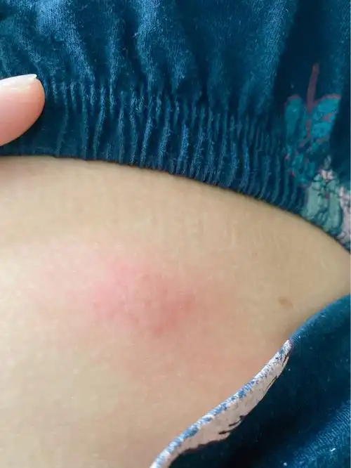 求助大家,宝宝被跳蚤叮咬之后肿起了大红包,巨痒无比,睡觉都睡不好,有