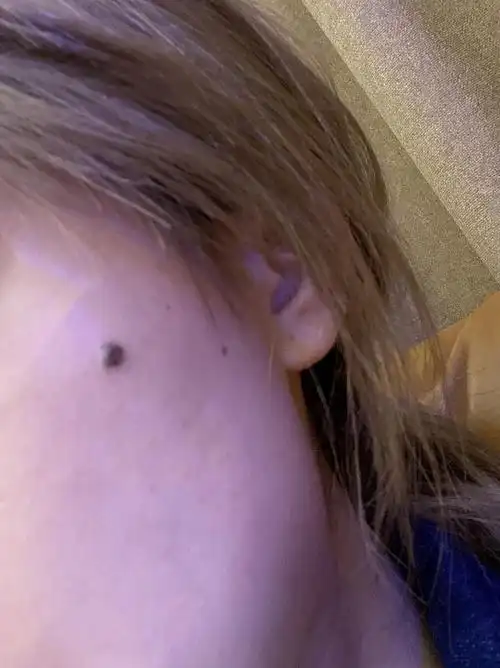 脸上长了一颗长毛的痣