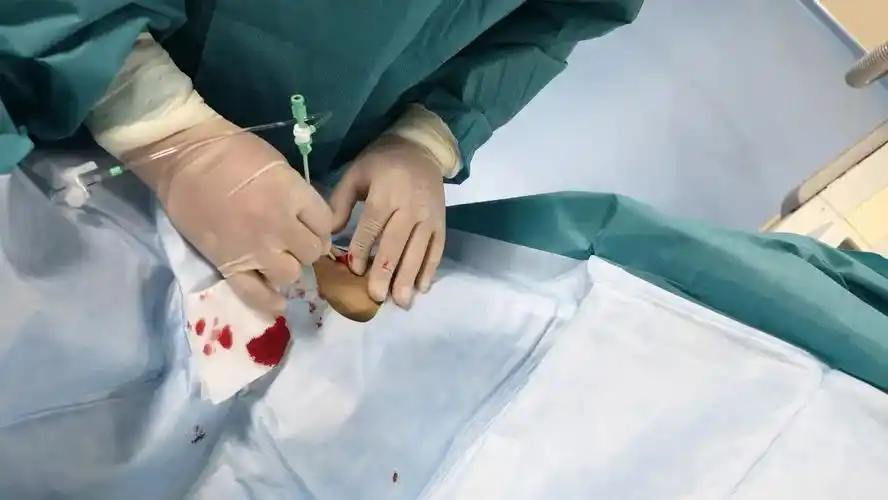 医院直通车揭秘手术全过程原来支架这样放进心脏的