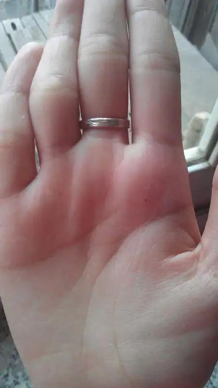 右手手掌最近长了一颗痣