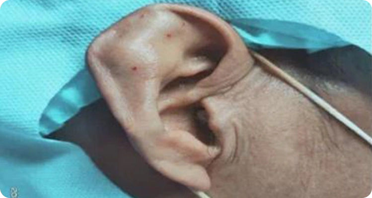 耳鼻喉科普耳朵长包不用担心这是耳廓假性囊肿