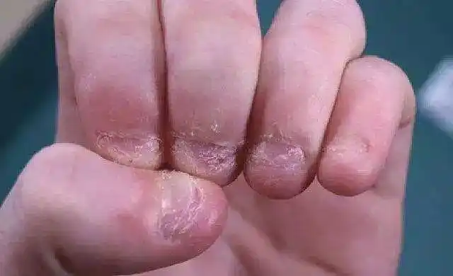 放开指甲别再咬了爱咬指甲的人快来看看这些危害