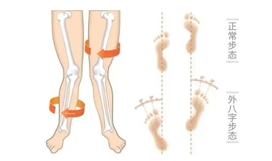 外八字脚怎么矫正?科德曼专业高效值得信赖