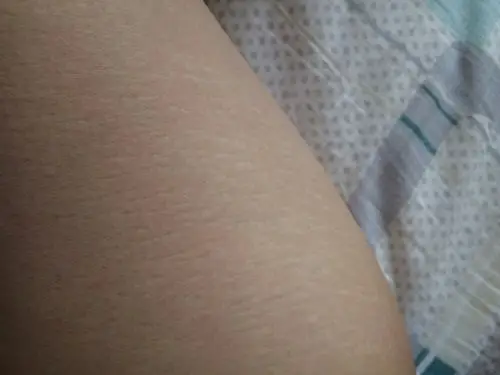 本人女,22岁,大腿内侧有就像花斑那样的,这是什么情况啊,求解惑啊!