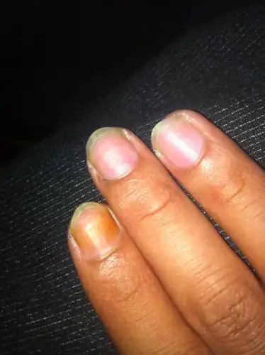 抽烟手指变黄了 因为常用这手指弹烟灰 就是今年 以前一直不会 一直