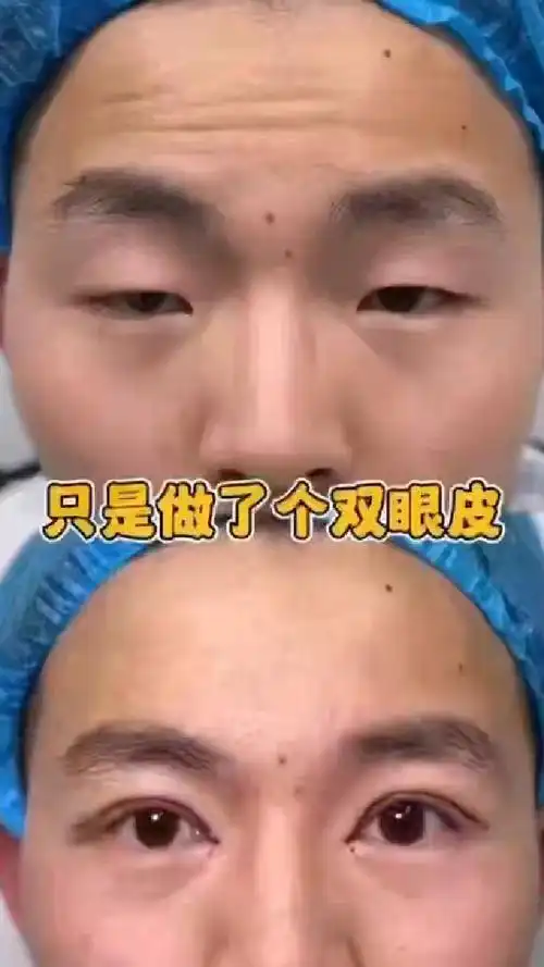 眼部提肌无力,睁不开眼,抬不起头