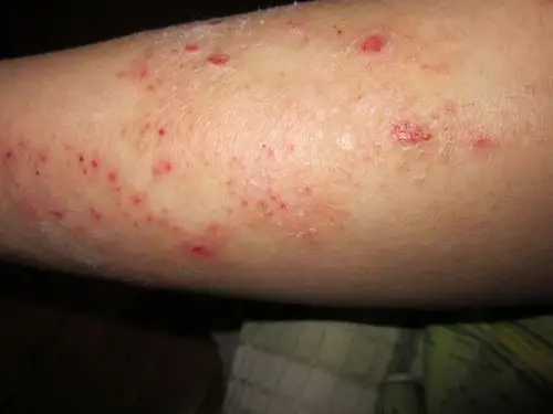 女朋友去年被蚊子咬了,感染了,好像变成皮炎湿疹了,朋友们给看看