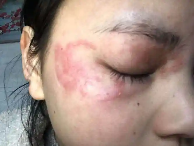 病毒性皮炎用肤肤笑可以康复