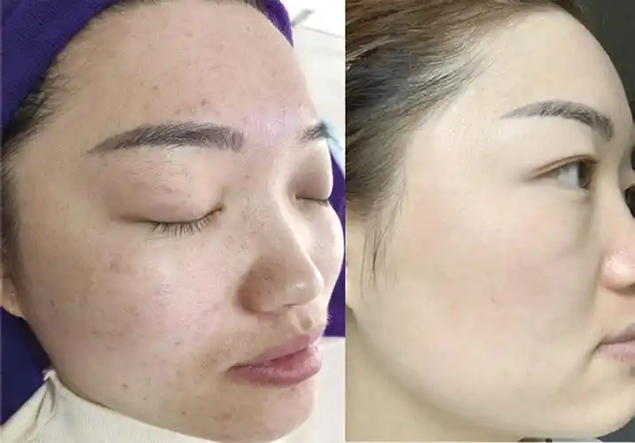 祛斑对比图