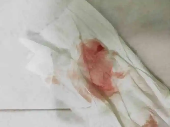 求囊胚移植后成功着床出血的真实图片