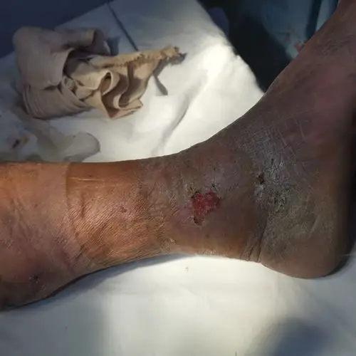 术后见踝关节皮肤溃疡面见新鲜肉芽组织生长4月27日,林老伯因左侧下肢