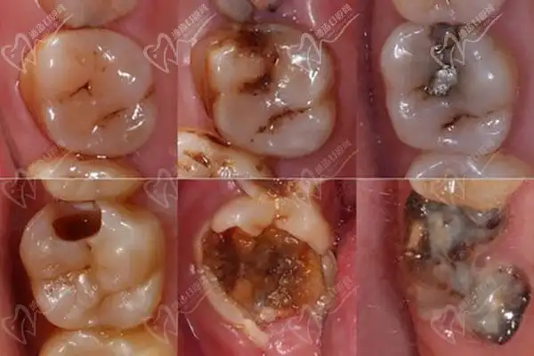 热搜蛀牙烂到牙神经有多疼告诉你牙齿烂到牙神经了怎么办