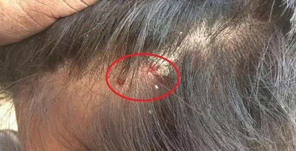 头上出现小红点是什么原因你知道吗