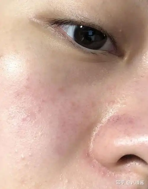 脸上看着又黄又糙怎么去角质才能不伤害皮肤有什么好用的脸部去角质